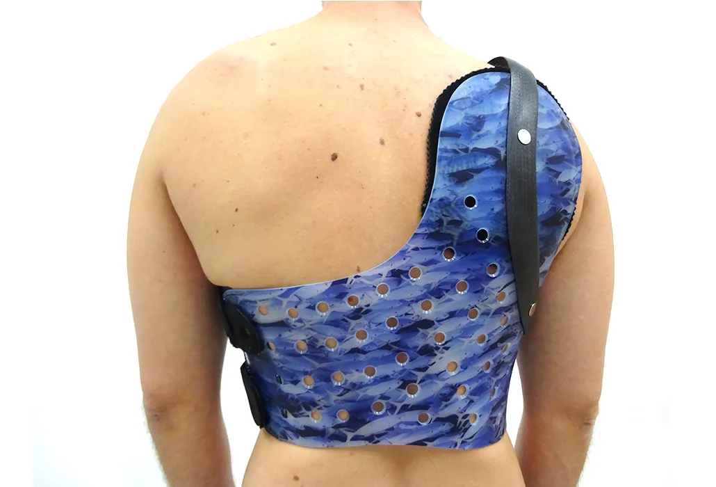 Orthotec Orthopädietechnik Orthesen Schulterorthesen Massanfertigung Scapula Alata Orthese